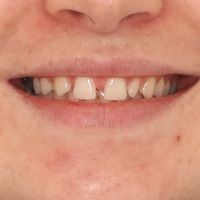 Porcelain Veneers - Smile 1 before